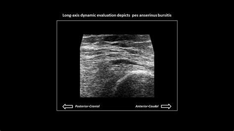 Pes Anserinus Bursitis On Knee Ultrasound Youtube