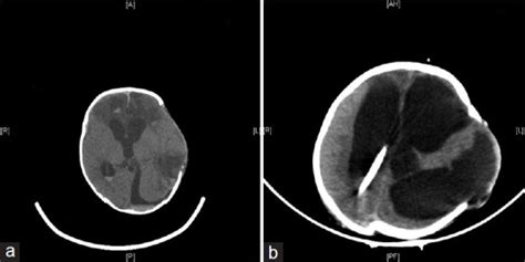 A 1 Month Infant Developed Post Traumatic Hydrocephalus After