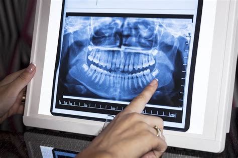 Radiologia Digital Vantagens Para O Consultório Odontológico Surya
