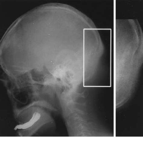 Lateral Skull Radiographs Showing Extensive Destruction And