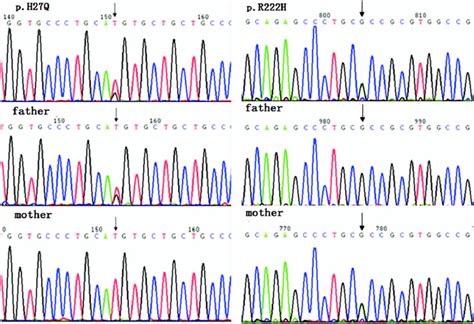 The Sanger Sequencing Revealed Novel Compound Heterozygous Mutations Of Download Scientific
