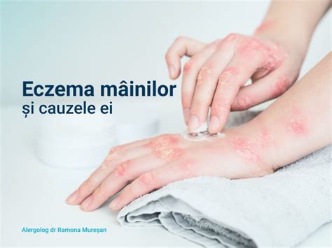 Eczema Maini Cauze Si Tratament