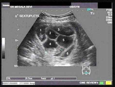 mom thinks she s having twins then doctors look at the ultrasound and tell her she s carrying
