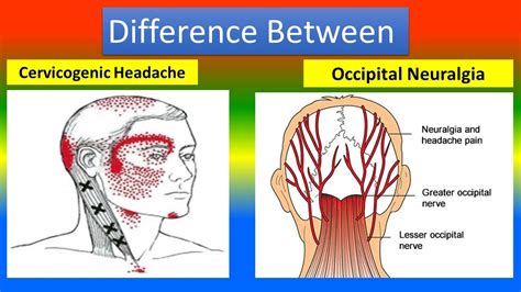 Difference Between Cervicogenic Headache And Occipital Neuralgia