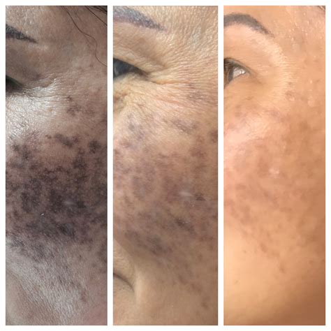 Absondern Pebish Array Laser Treatment For Brown Spots On Face