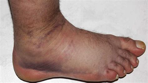 Unexplained Bruising On Feet Diabetes Diabeteswalls