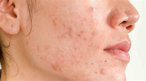 What Causes Hormonal Acne And How To Get Rid Of It Hero Cosmetics