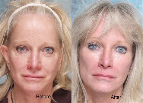 Midface Surgery Case Studies Beverly Hills Cheek Lift Cases Los Angeles