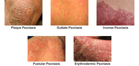 Chronic Psoriasis Treatment Orlando Associates In Dermatology