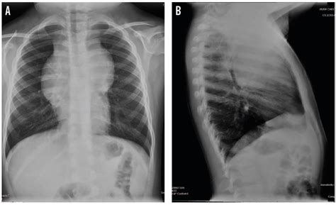 T Cell Lymphoblastic Lymphoma In A Boy With A Mediastinal Mass