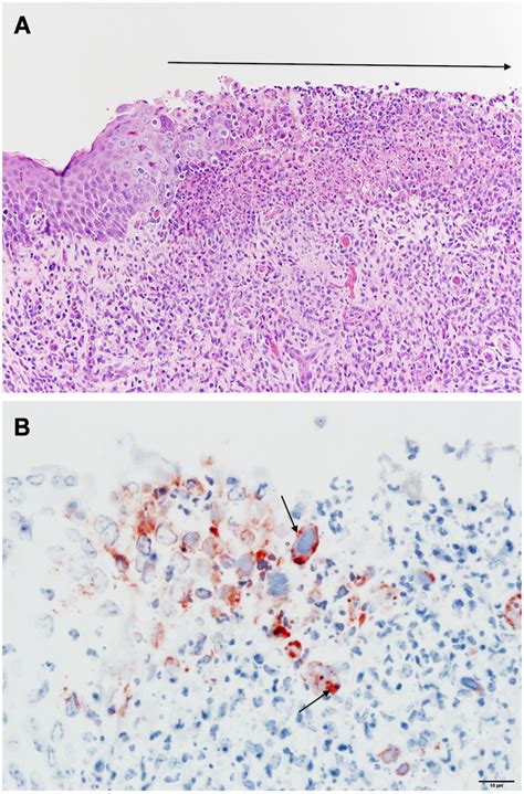 Histopathology Of Pharynx From Ibr Infected Steer A Focal Ulcerative