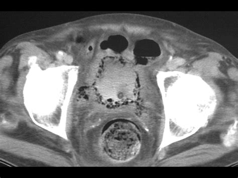 Image Library Bladder Infection Bmc Radiology