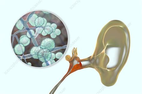 Chronic Fungal Otitis Media Ear Infection Illustration Stock Image