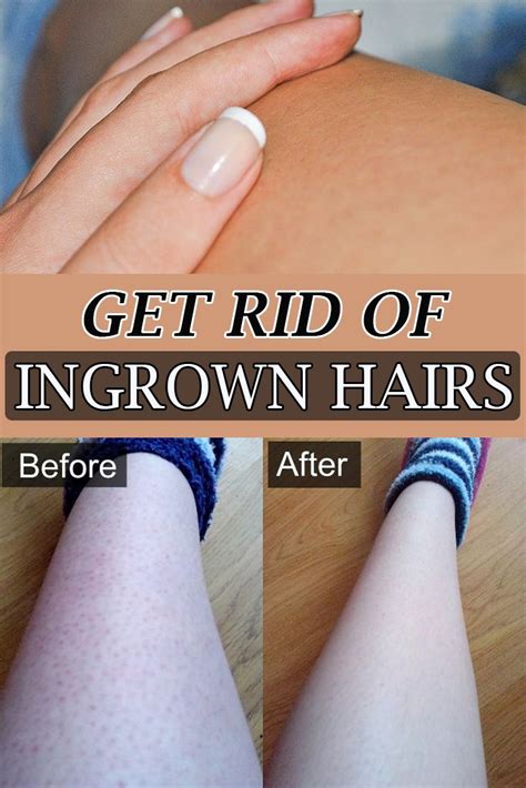Read about ingrown hair symptoms, signs, causes, treatment, and prevention. Get rid of ingrown hairs | Ingrown hair, Ingrown hair ...
