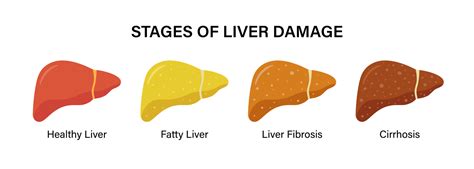 Stages Of Nonalcoholic Liver Damage Healthy Fatty And Cirrhosis