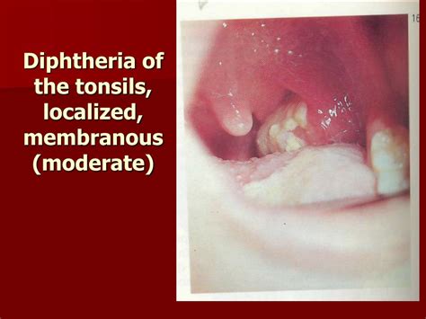 Ppt Infectious Diseases With Tonsillitis Diphtheria Powerpoint