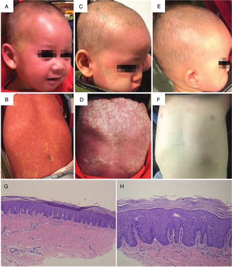 Successful Treatment Of Severe Pityriasis Rubra Pilaris With