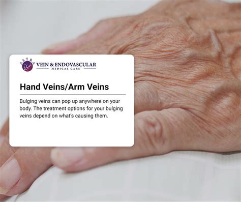 Hand Vein Treatment In Bronx Although Its Rare Bulging Veins On