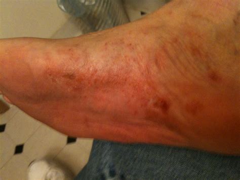 Rash On Bottom Of Foot Pictures Photos