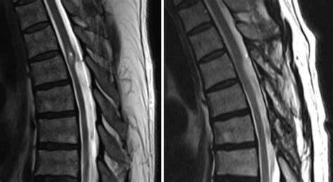 Spinal Arachnoid Cysts In Adults Diagnosis And Management A Single