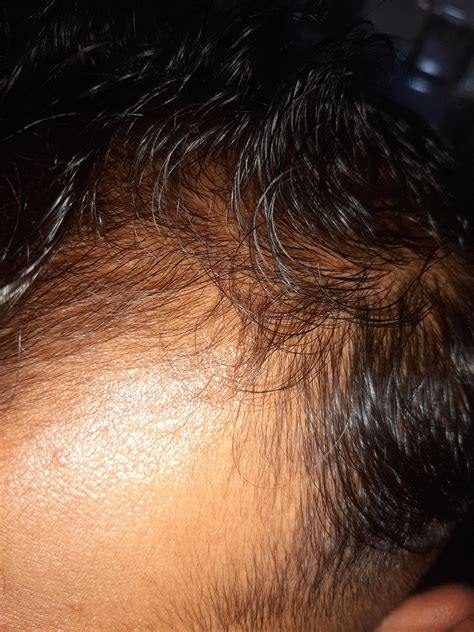 2month Minoxidil Lot Of Baby Hairs In Temple Are It Is Progress