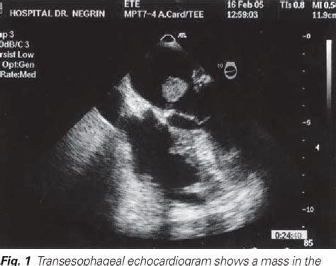 Figure 1 From Resection Of A Left Atrial Hemangioma Report Of A Case