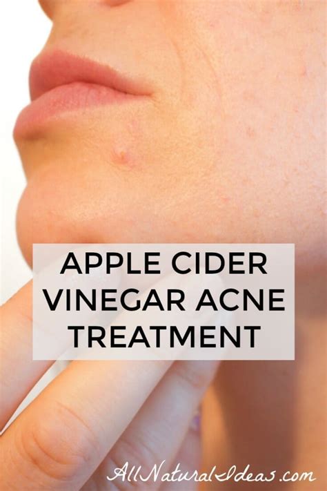 Apple Cider Vinegar For Acne Skin Breakouts All Natural Ideas