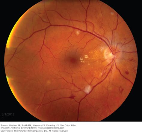 It is not particularly important to be able to distinguish between small haemorrhages and microaneurysms as they are both parts of. Hypertensive Retinopathy | Basicmedical Key