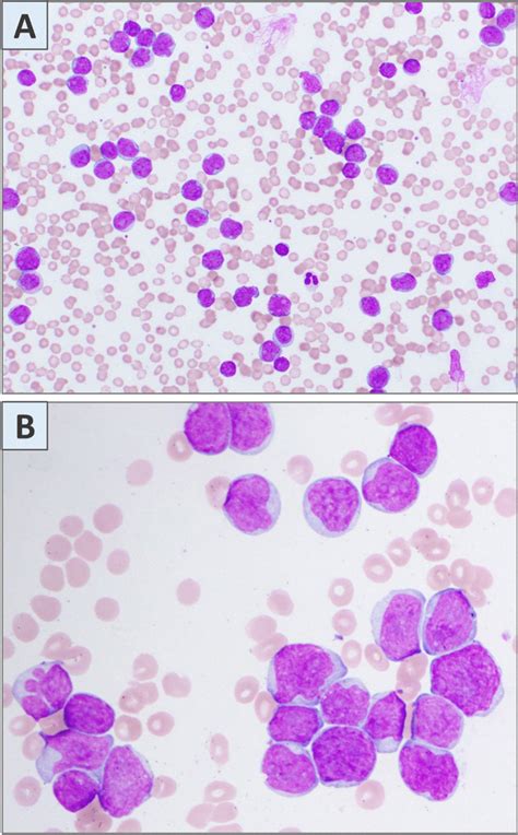 Ab Marked Leukocytosis With Intermediate To Large Sized Neoplastic