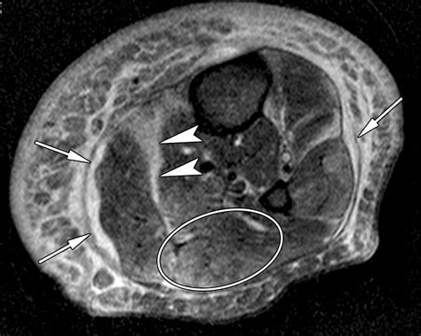 Soft Tissue Infections And Their Imaging Mimics From Cellulitis To