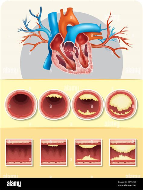 Diagram Showing Fat In Human Heart Stock Vector Image And Art Alamy