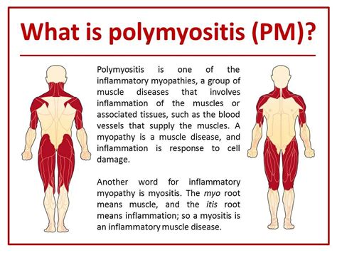 Pin By Redacted On Autoimmune Disease Warriors Polymyositis Muscle