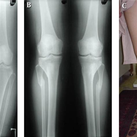 Pdf Proximal Tibial Osteotomy In Patients With Varus Knee Deformity