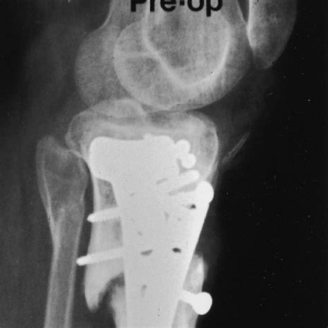 Pdf Total Knee Arthroplasty After Open Reduction And Internal