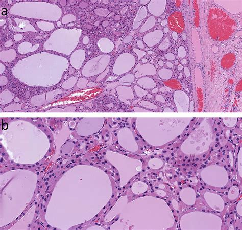 Frontiers Oncocytic Change In Thyroid Pathology