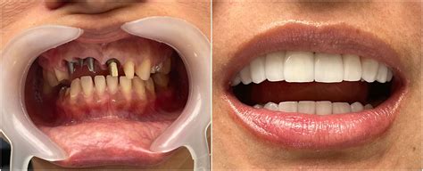 Implantes dentales Antes y después Clinicasesteticas com co
