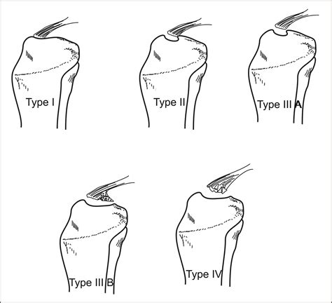 Tibial Spine Avulsion Fractures Current Concepts And Technical Note On Arthroscopic Techniques