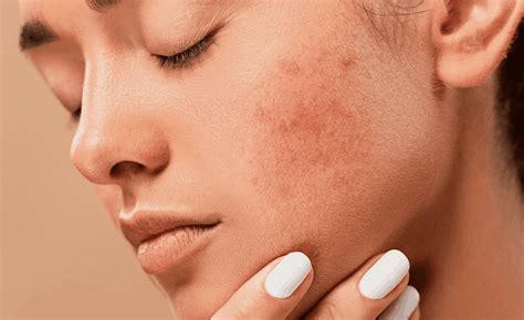 Regain Your Confidence Microdermabrasion For Acne Scars Works