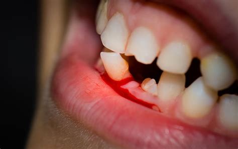 Dream About Teeth Falling Out With Blood 6 Spiritual Meanings
