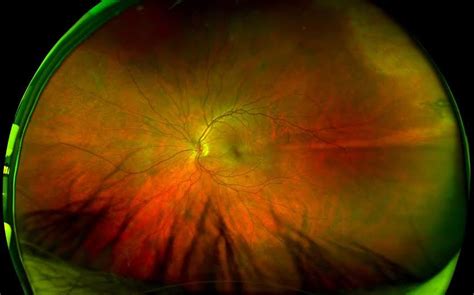 How Retinal Imaging Can Save A Life A Case Study Retinal Photography