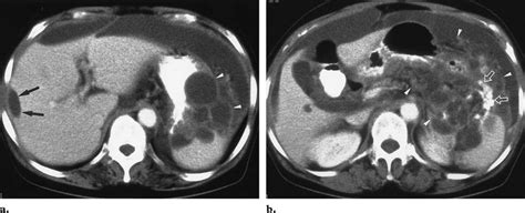 Serous Cystadenocarcinoma Of The Ovary With Peritoneal Carcinomatosis