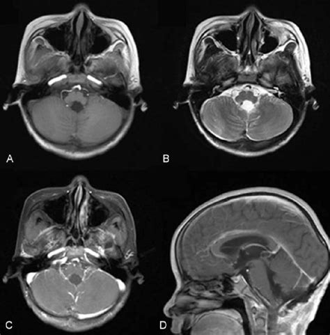 Mr Images Of The Brain 1 Week After Resection Of The Tumor A An