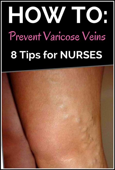 Learn how to get off the sad diet and start changing your life! HOW NURSES CAN PREVENT VARICOSE VEINS — 8 TIPS ...