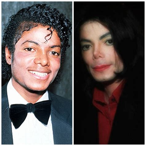 Before And After Celebrities With Vitiligo~introduction ~chapter 1