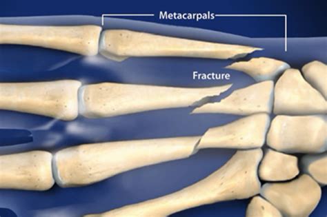 Best Fracture Finger And Metacarpal Fractures Treatment Clinic In Central