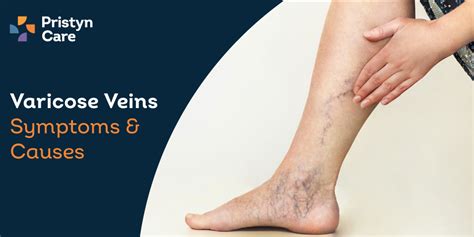 Varicose Veins Symptoms And Causes Pristyn Care