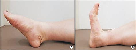 Figure 5 From Chronic Tibialis Anterior Tendon Rupture Treated With Semitendinosus Autograft A