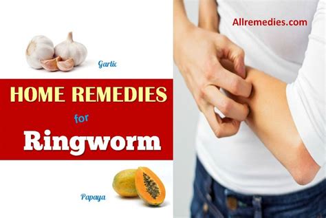 40 Natural Home Remedies For Ringworm In Humans