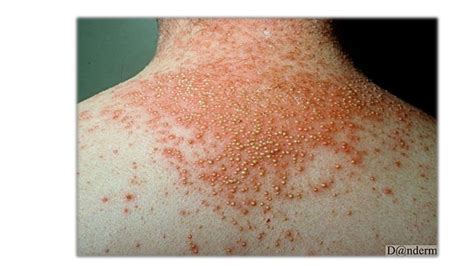 Psoriasis