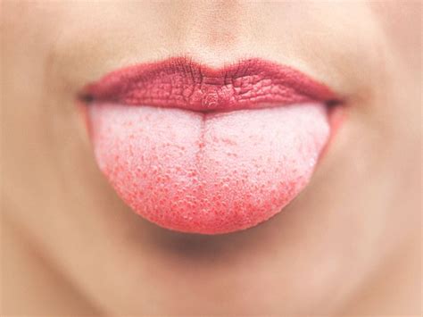 Lie Bumps Transient Lingual Papillitis Canker Sore On Tongue